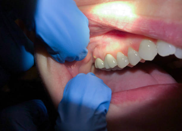 Best Emergency Root Canal Treatment in Underwood Petersville, AL